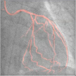 Dynamic Coronary Roadmap